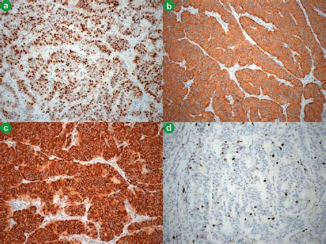 Immunohistochemical Examination Of The Resected Pancreatic Mass