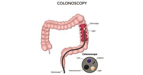 Colonoscopy And Inflammatory Bowel Disease Ibdrelief