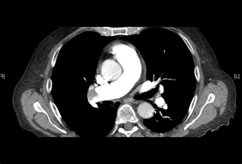 Pulmonary Embolism Clot In Transit