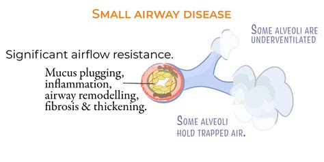 USMLE COMLEX Step 1 Glossary COPD For USMLE Step 1 Ditki Medical