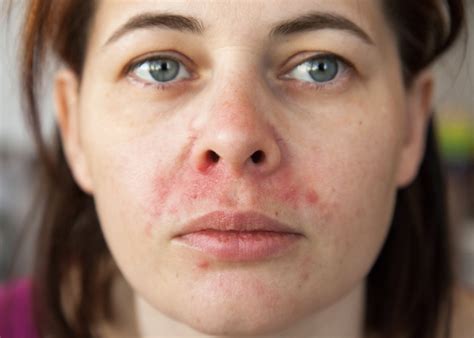 Natural Treatments For Perioral Dermatitis Your Remedy Naturopathy
