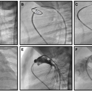 Pulmonary Valve Perforation A Preprocedural Right Ventricular Outflow