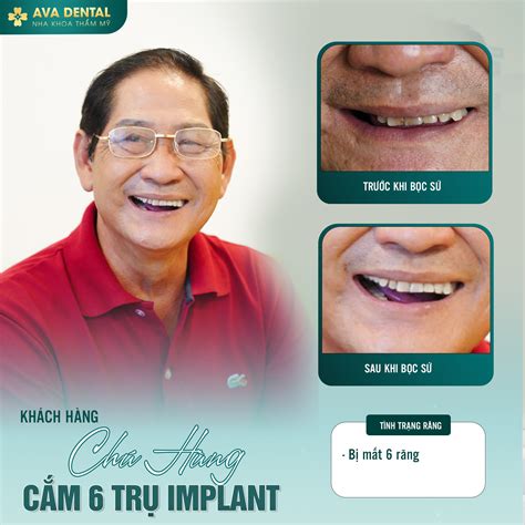 R Ng Ch C Kh E N C I R Ng R Nh Tr Ng Tr Implant T I Ava Dental