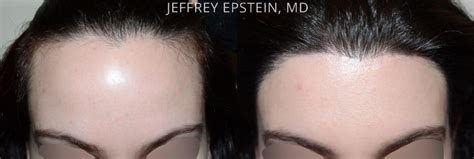 Hair Transplants For Women Photos Miami Fl Patient42126