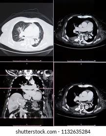 Computed Tomography Ct Scan Chest Abdomen Stock Photo