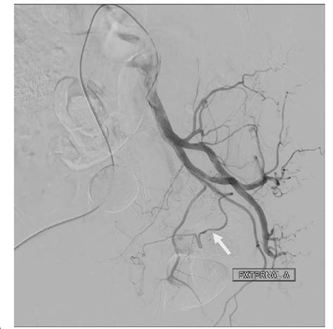 Obturator Artery Angiogram