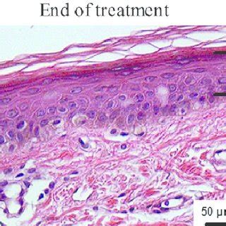 Radiofrequency Treatment Enhances Epidermal Hyperplasia Skin Biopsy