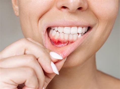 Canker Sores What They Are What Causes Them How To Treat And Prevent