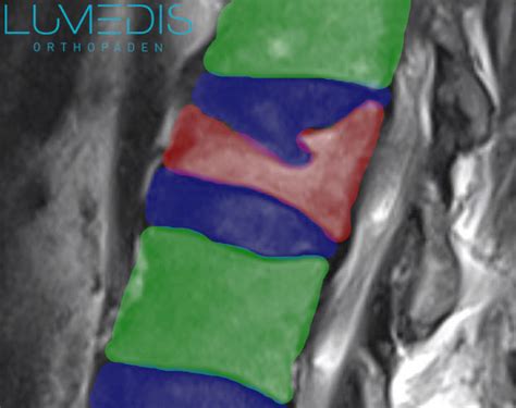 Deckplattenimpressionsfraktur Lumedis Ihre Wirbels Ulenspezialisten