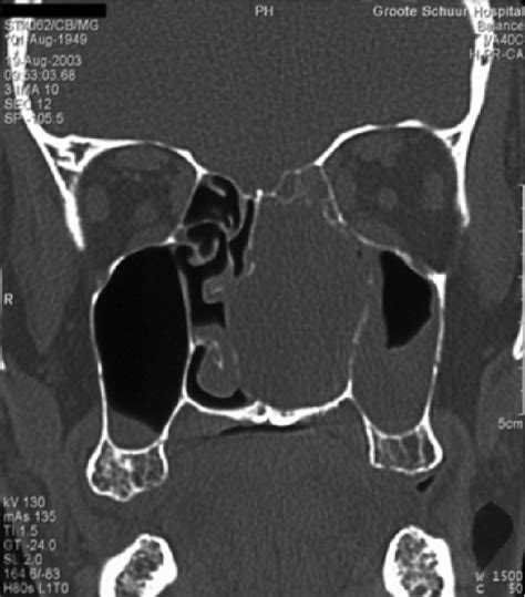 Figure 1 From Ancient Schwannoma Of The Nasal Cavity A Rare Cause Of