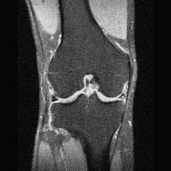 Mri Knee Coronal