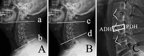 A The Measurement Method For Cervical Cobbs Lordosis The Angle Formed Download Scientific