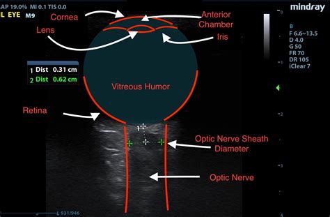 Idiopathic Intracranial Hypertension And Optic Nerve Sheath Diameter Jetem