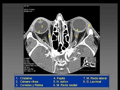 TC De Orbitas Tomografia Computada Lic Alejandra Galvez Radiology