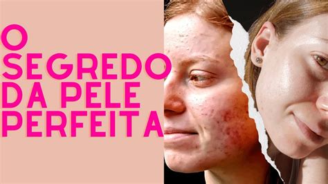 Peróxido De Benzoíla Antes E Depois - PERÓXIDO DE BENZOÍLA: UM ANO DE USO | antes e depois - BENZAC 5 - YouTube