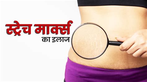 Stretch Marks Treatment कमर पर द‍िख रहे स्ट्रेच मार्क्स जल्‍दी हो सकते