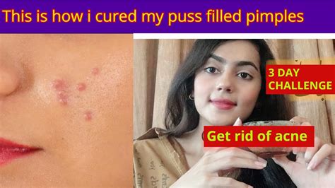 Home Remedy To Cure Puss Filled Pimples Get Rid Of Acne Get Rid Of Puss Pimples Youtube