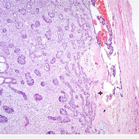 Photomicrograph Showing Follicle Of Odontogenic Epithelium Resembling