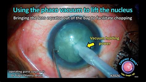 Cataractcoach Using Phaco Vacuum To Lift The Nucleus Youtube