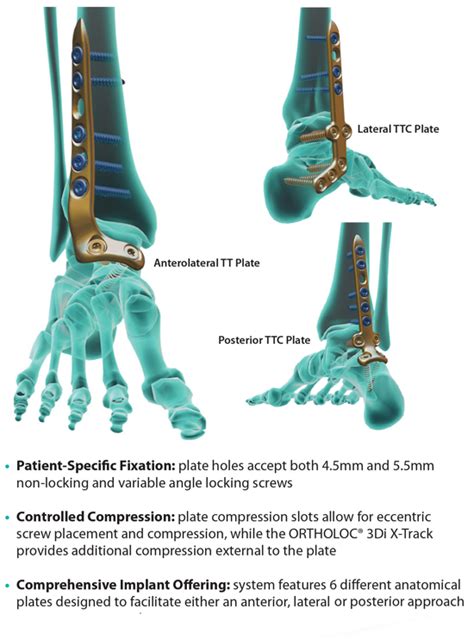 Foot And Ankle Archive Page 4 Of 6 Wright Medical Group