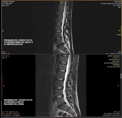 Ozonoterapia Nel Trattamento Dell Ernia Del Disco Cervicale E Lombare