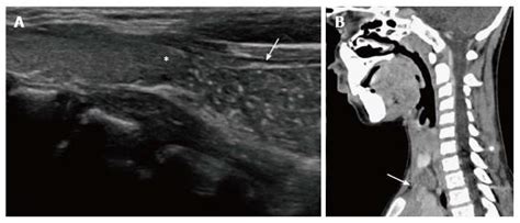 Imaging Of The Pediatric Thymus Clinicoradiologic Approach