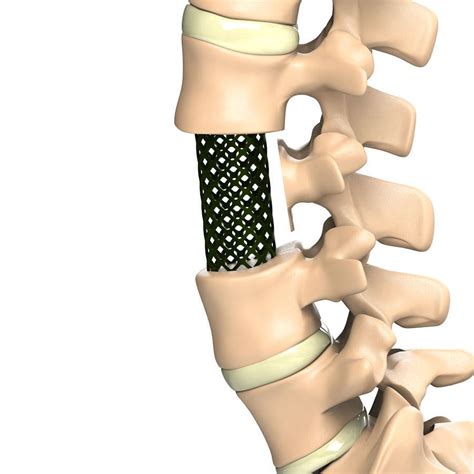 Prótese vertebral lombar Ti 6Al 4V ELI Aditus Medical expansiva