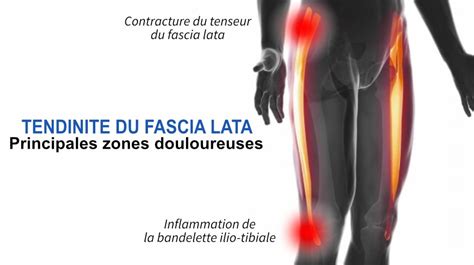 Tendinite Du Fascia Lata Causes Et Solutions Pro Physio