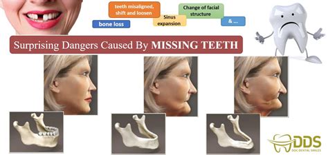 Consequences Of Missing Teeth Docdentalsmile