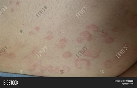 Erythema Multiforme Annular Erythematous Targetoid Skin Lesions Stock