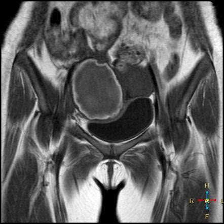 Hemorrhagic Ovarian Cyst Mri