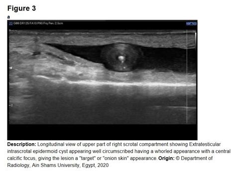 Longitudinal View Of Upper Part Of Right Scrotal Compartment Showing