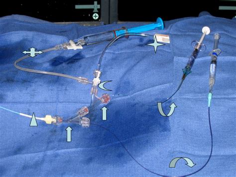 Pulmonary Arteriovenous Malformation Embolization How We Do It