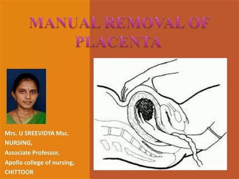 Manual Removal Of Placenta Pptx