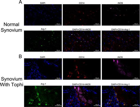 Distinct Macrophage Polarization In Acute And Chronic Gout Laboratory