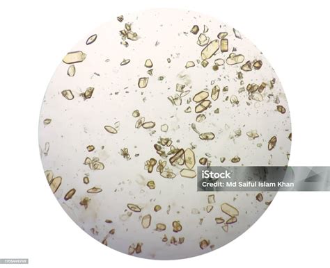 Photomicrograph Of Uric Acid Crystal In Urine Sediment Stock Photo