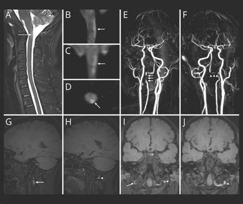 Neurology Journal On Twitter Neuroimage Unilateral Upper Cervical