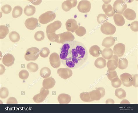 Myelodysplastic Syndrome Showing Dysplastic Granulocyte Stock Photo