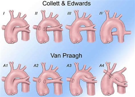 Truncus arteriosus causes, symptoms, diagnosis, treatment & prognosis