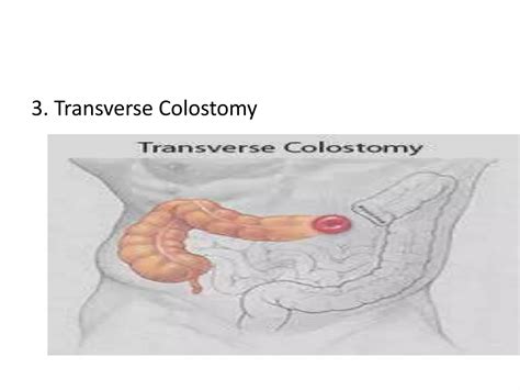 Colostomy | PPT