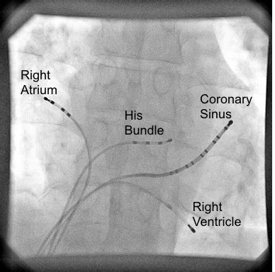 Electrophysiology Study | Heart Rhythm Clinic