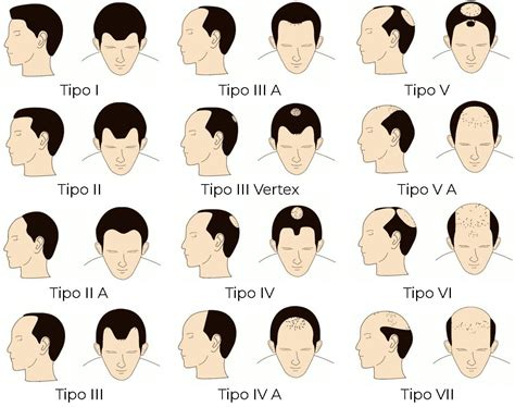 Escalas de Alopecia Clínica Capilar