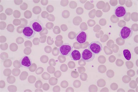 Oral Myeloid Sarcoma Lesions Linked to Acute Myeloid Leukemia - Today's RDH