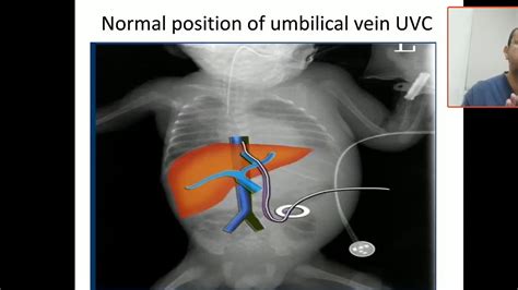 Case Study Umblical Venous Catheter Position And Malposition Youtube