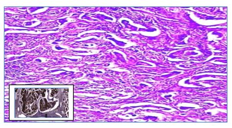 A Cross Sectional Study Of Tumor Budding In Correlation With