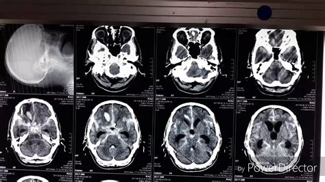 Subarachnoid Hematoma Ct Scan