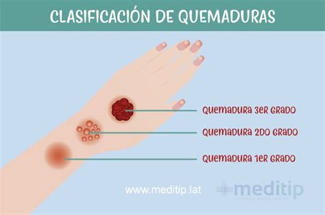 Quemaduras Causas Tipos Y Recomendaciones Meditip