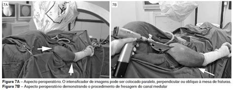 Scielo Brasil Dispositivo De Tra O Do Membro Superior Para