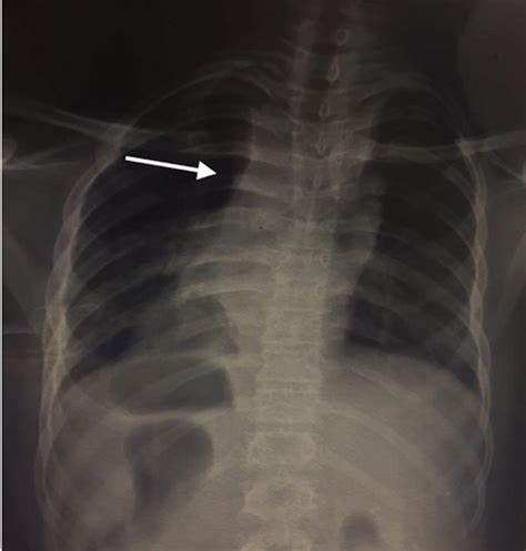 Chest X Ray Showing Mediastinal Widening Download Scientific Diagram