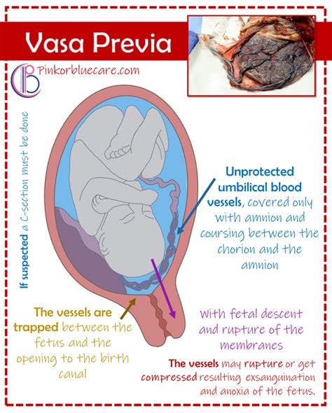 Vasa Previa Nursing School Survival Nursing School Tips Obstetrics